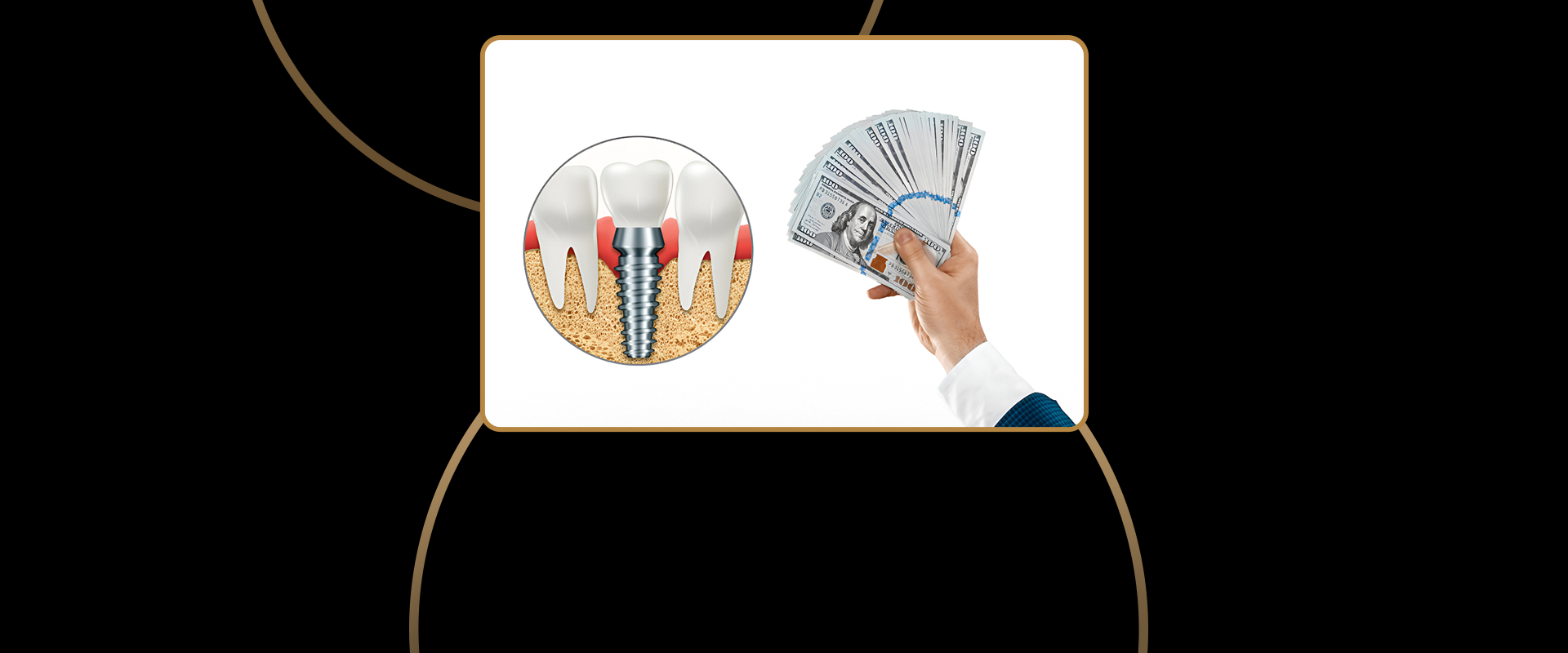 Cost of Dental Implants